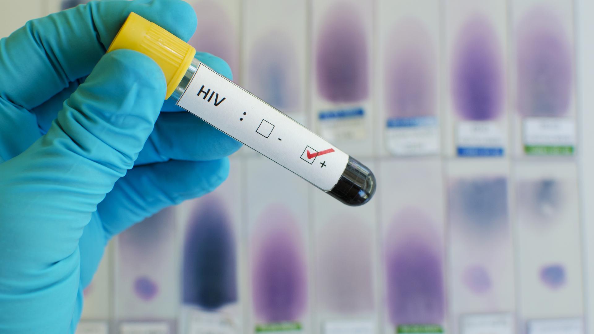 Pour la première fois depuis 2015, le nombre de nouvelles infections au Luxembourg recule en 2018, selon des données encore provisoires.